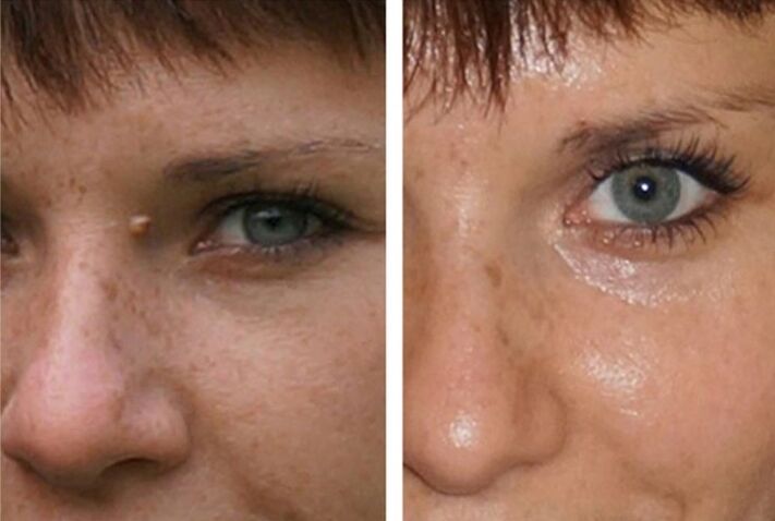 pred in po laserskem odstranjevanju papiloma fotografija 1