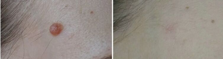 pred in po laserskem odstranjevanju papiloma fotografija 2