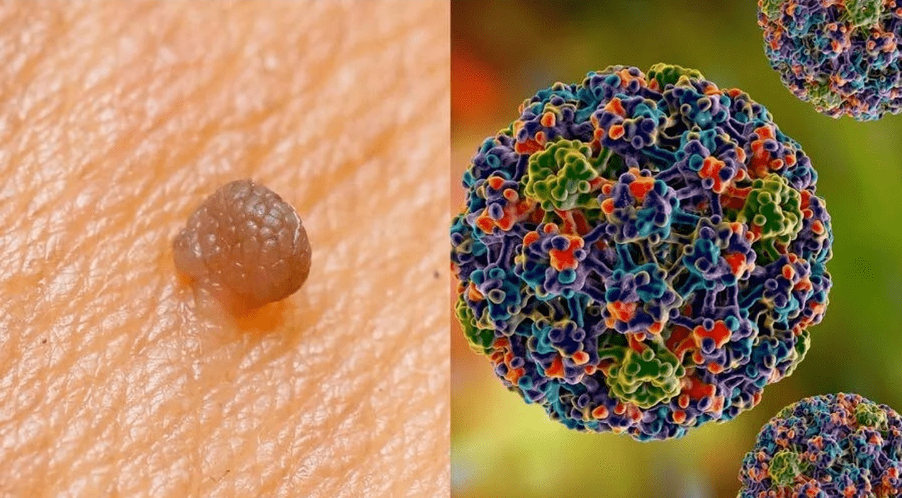 humani papiloma virus
