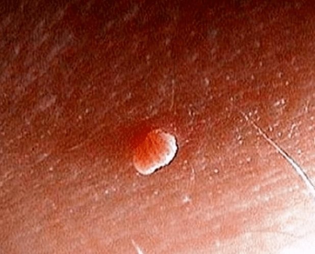 Papiloma na telesu