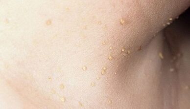 tveganje za nastanek papilomatoze na vratu