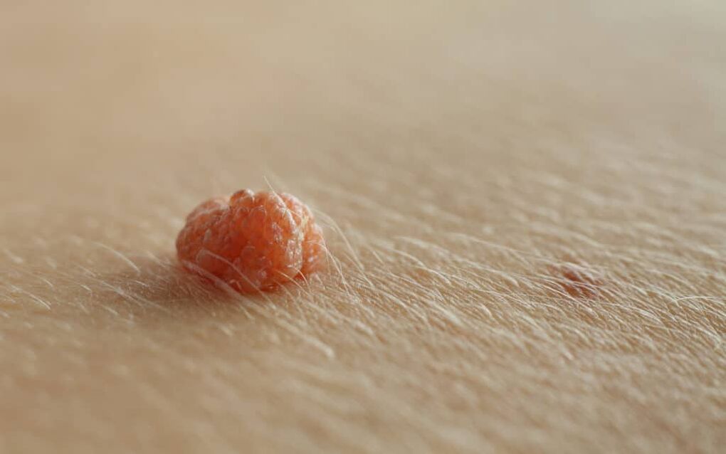 papiloma