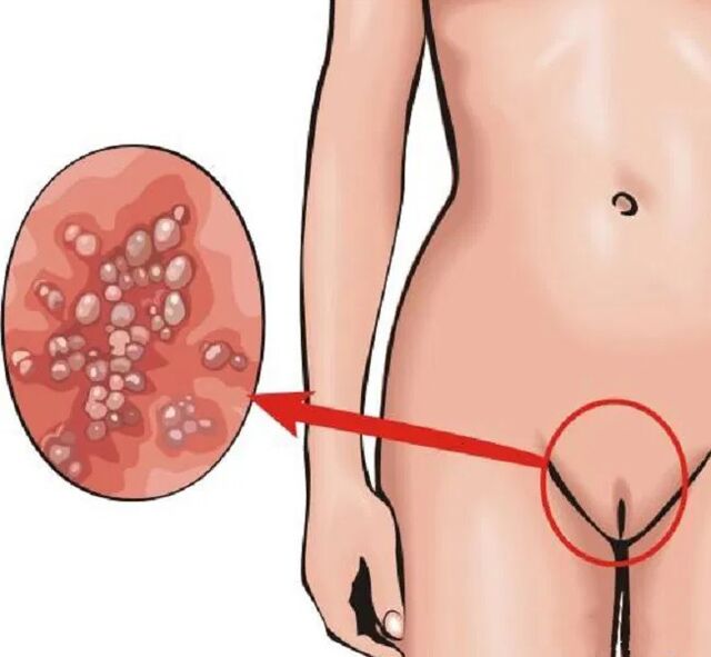 papilomi v perineumu