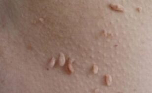 Filiformni papilomi