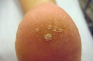 Plantarna bradavica